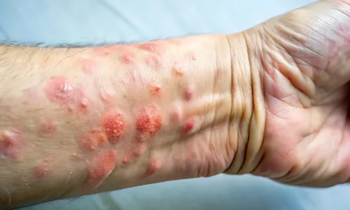 Allergic contact dermatitis