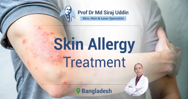 Skin allergy treatment in Bangladesh | 
