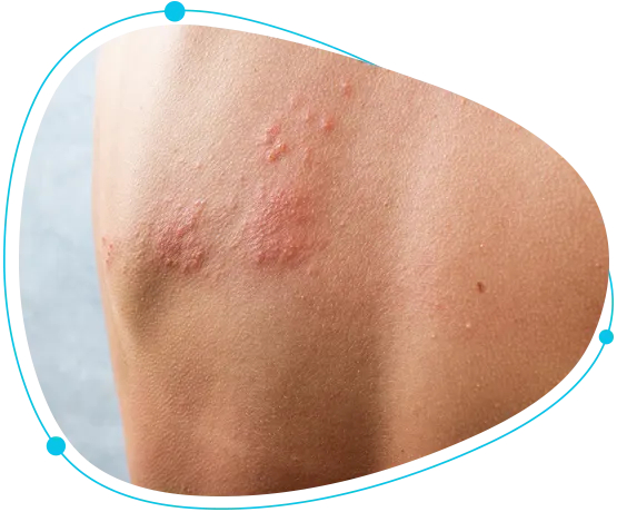 Atopic dermatitis (eczema) treatments in Bangladesh