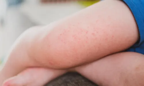 Atopic dermatitis or eczema