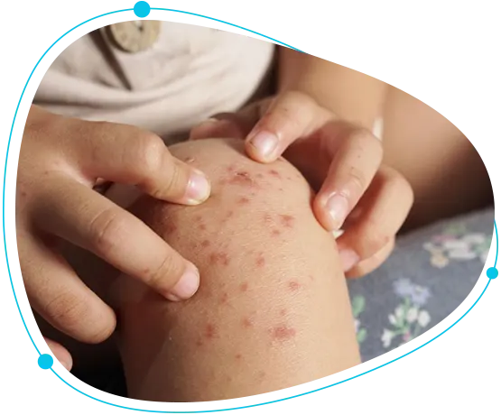 Skin allergy treatment for children