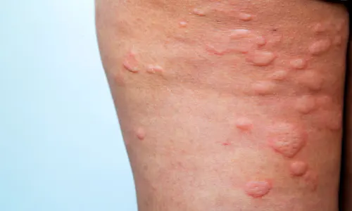 Drug-related skin allergy