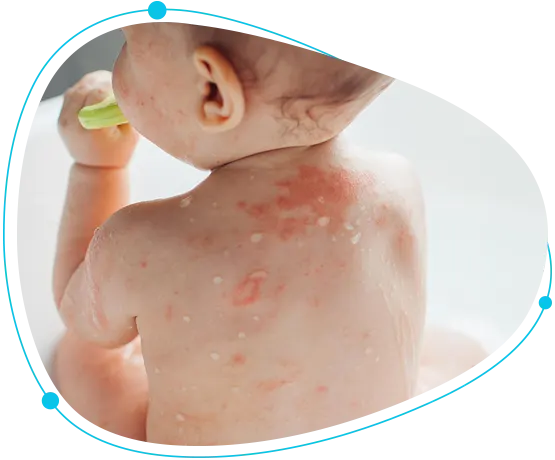Eczema treatment for babies and children