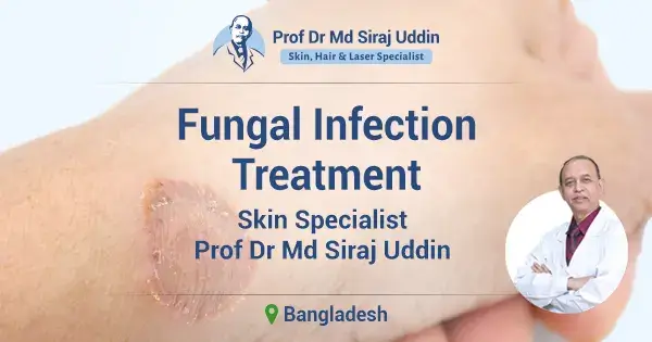 Fungal infection treatment in Bangladesh