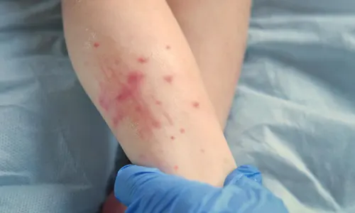 Insect-bite reactions