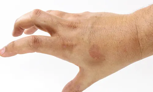 Irritant contact dermatitis