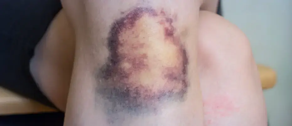 Laser tattoo removal side effects and skin reactions
