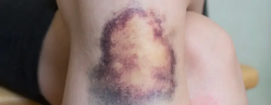 Laser tattoo removal side effects