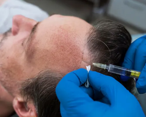 PRP therapy for hair growth