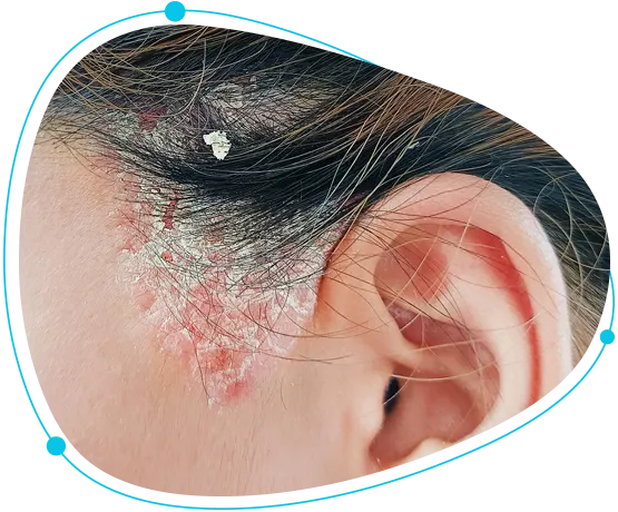 Scalp psoriasis home care