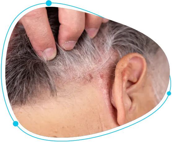 Scalp Psoriasis treatment in Bangladesh