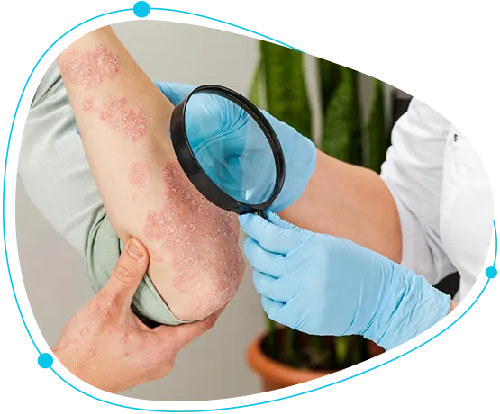 Skin allergy treatment in Bangladesh