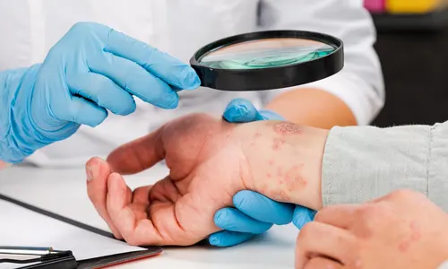 Skin Diseases