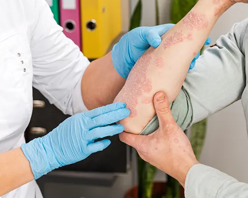 Systemic treatment for moderate or severe eczema