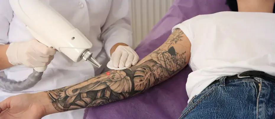 Tattoo removal aftercare dressing and skin protection