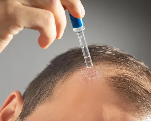 Topical steroid scalp solution