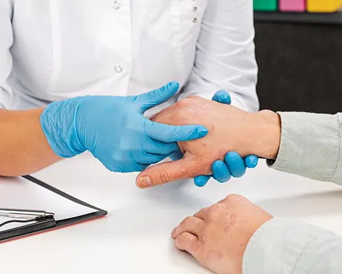 Treatment for infected eczema
