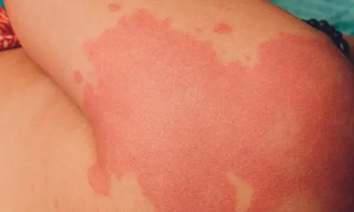Urticaria or hives